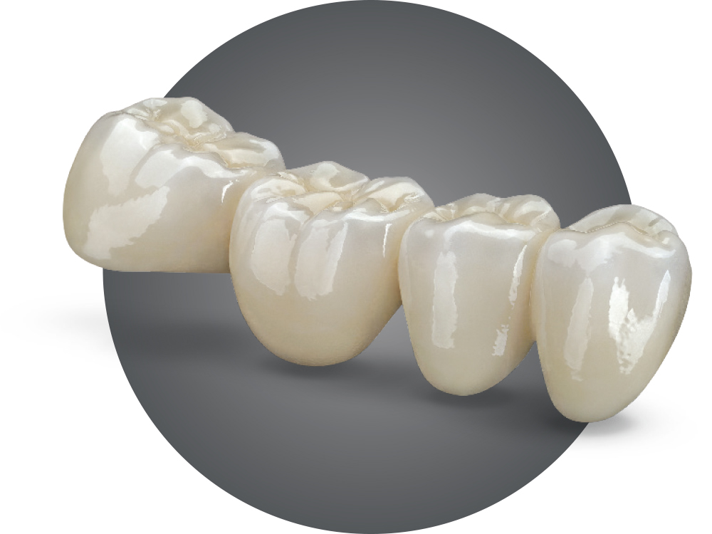 Multi-unit ceramic dental bridge at Greene Dental Associates in Fairborn, Ohio