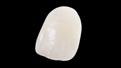 Same-day ceramic front-tooth crown at Greene Dental Associates in Fairborn, Ohio
