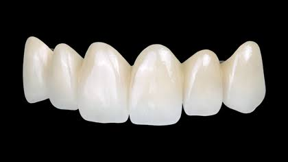 Front-teeth dental bridge at Greene Dental Associates in Fairborn, Ohio