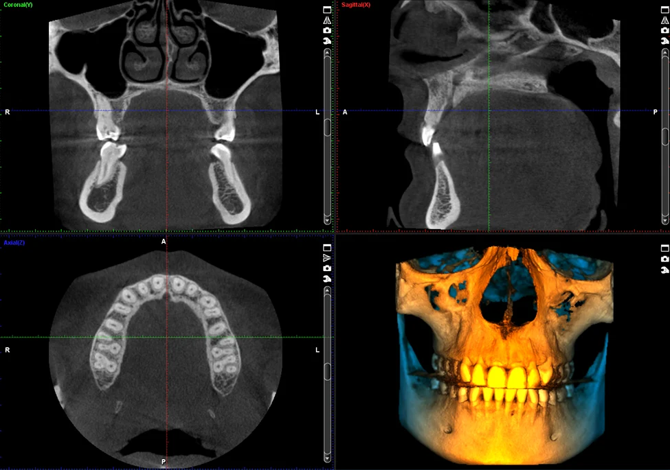 CBCT 3D scan views at Greene Dental Associates in Fairborn, Ohio