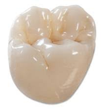 Same-day ceramic molar crown at Greene Dental Associates in Fairborn, Ohio