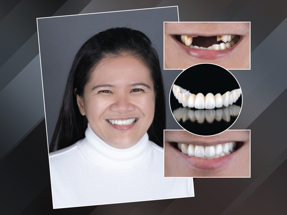 Porcelain veneers before and after at Greene Dental Associates in Fairborn, Ohio