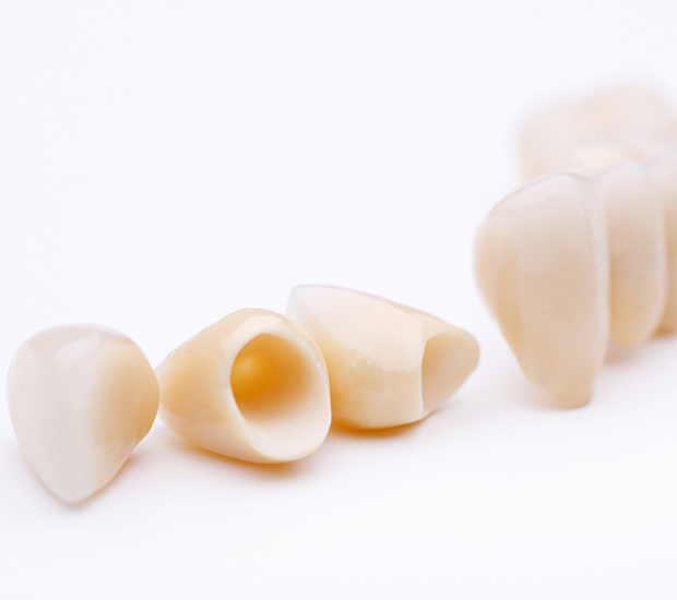 Fairborn Dental Crowns and Dental Bridges
