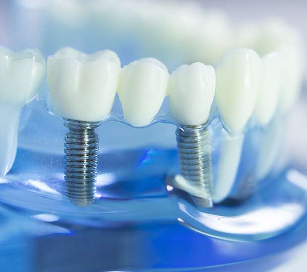 Fairborn Dental Implants